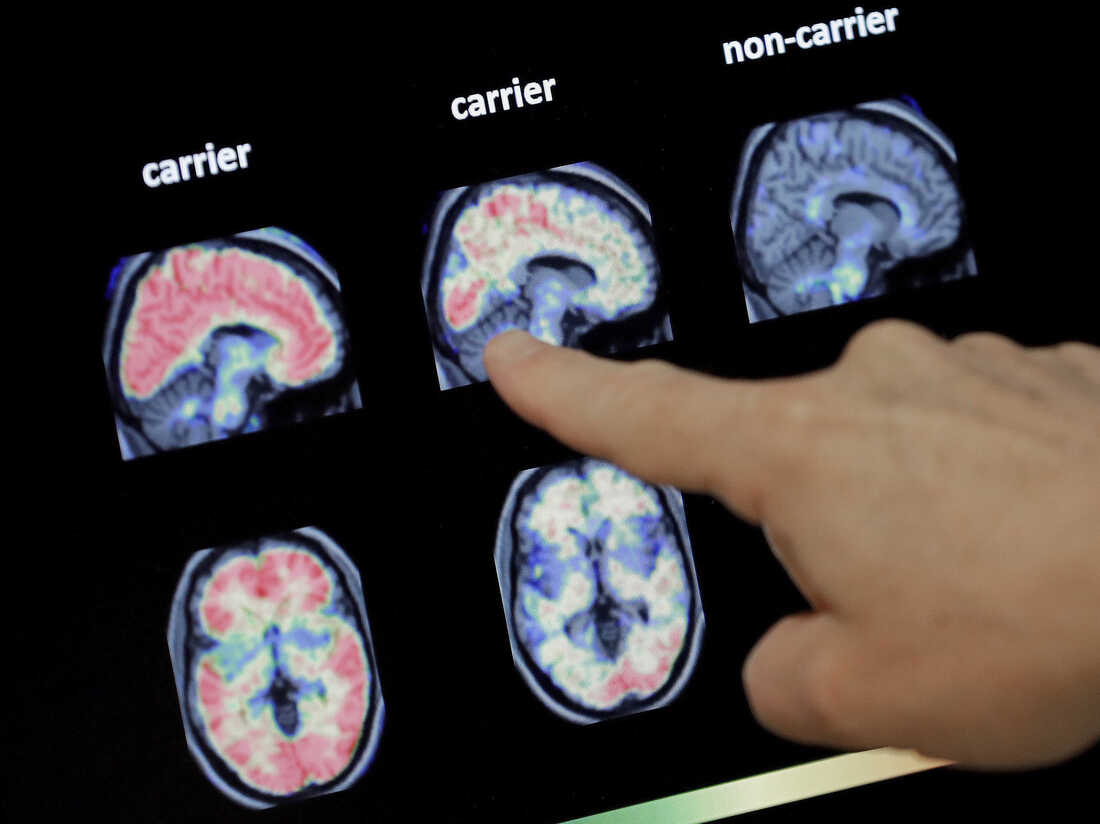 new research into alzheimer's disease