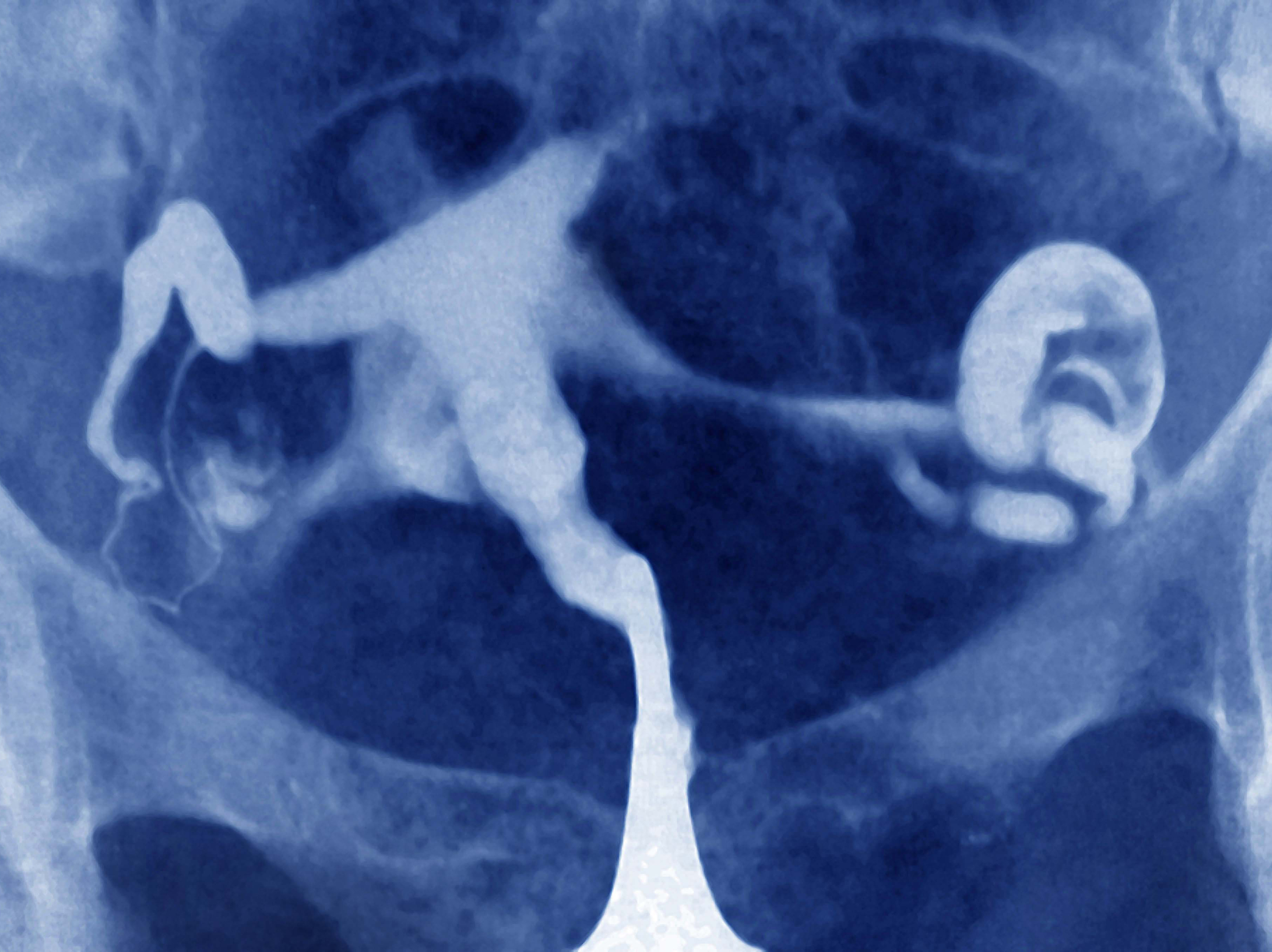 $80,000 and 5 ER visits: An ectopic pregnancy takes a toll