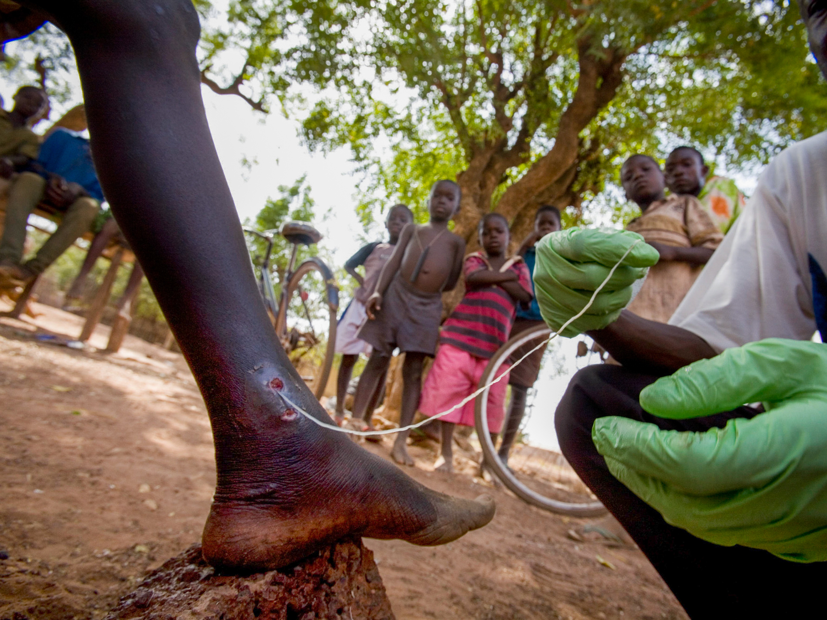 Jimmy Carter took on the awful Guinea worm when no one else would — and he triumphed 1 Medical worker Abaare Hussein extracts a Guinea worm from a child's leg in Savelugu Village in northern Ghana in 2007.