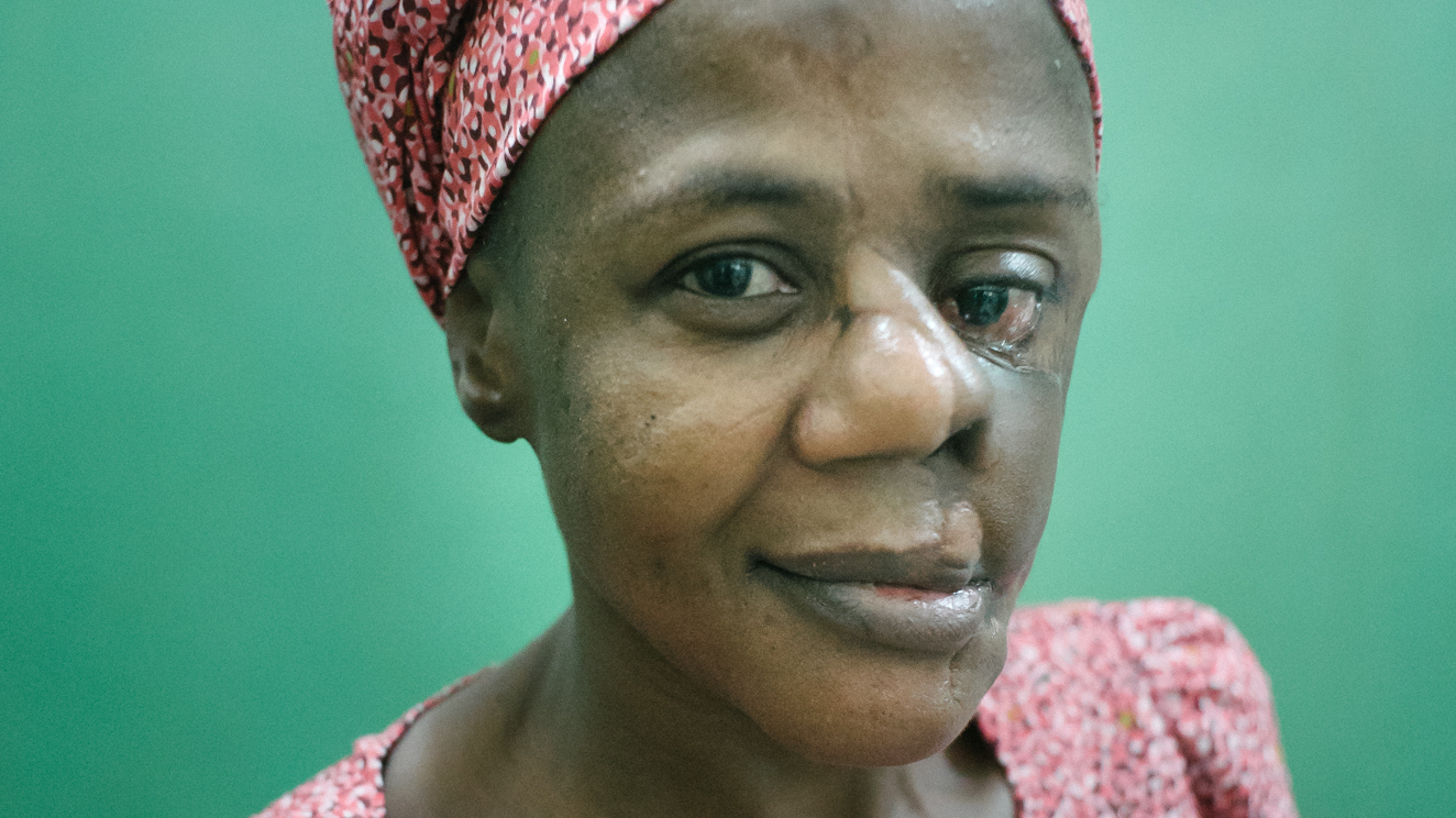 Mulikat Okanlawon of Nigeria contracted noma when she was a child. The gangrenous infection ate away at the flesh and bone in her face. She survived and has had surgery to repair scars left by the disease. Today she works at the Sokoto Noma Hospital, guiding noma patients on the road to recovery.