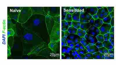 Why do some people get UTIs over and over? A new report holds clues