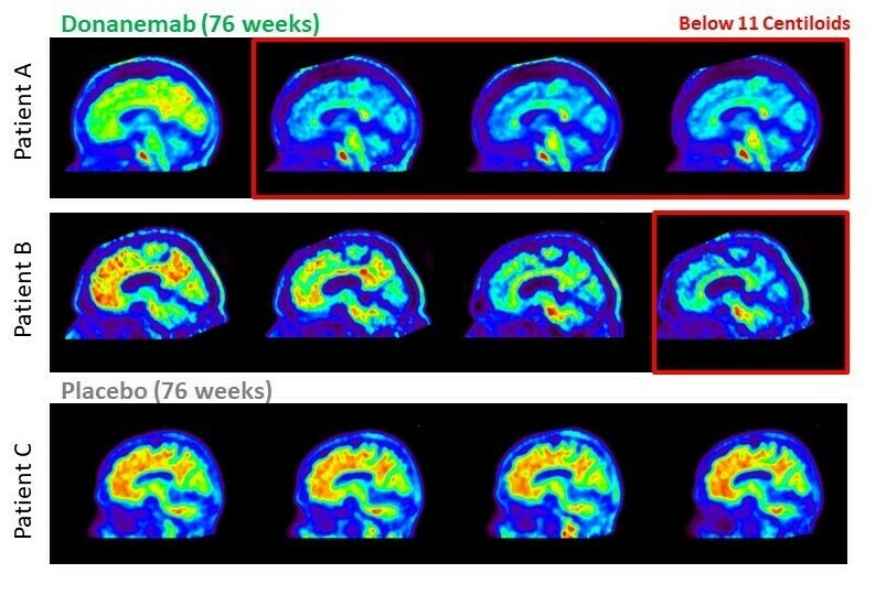 The image shows amyloid plaques in the brains of three patients in the early stages of Alzheimer's. Those plaques are greatly reduced in the first two patients, who got donanemab, but remain unchanged in a patient who received no treatment. (Eli Lilly and Company)