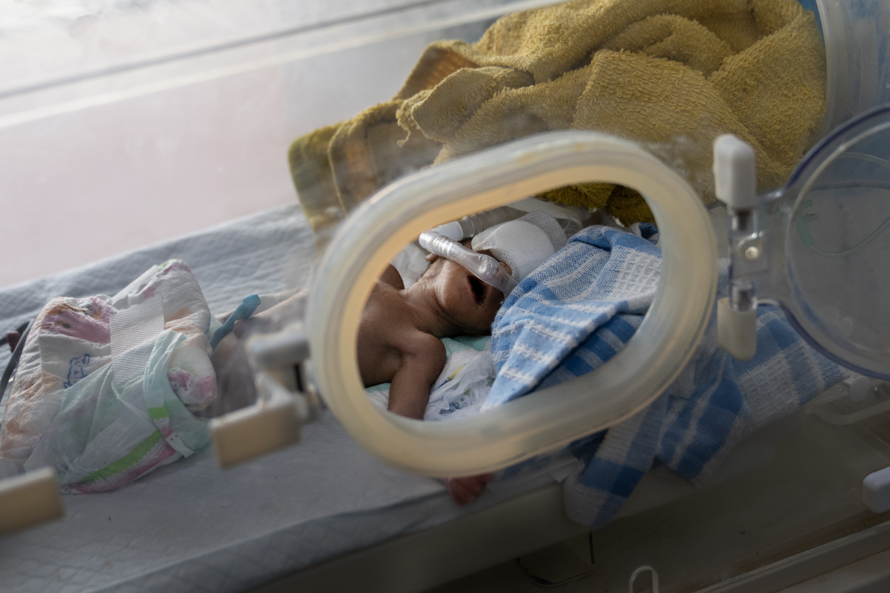 A baby is being treated for malnutrition in the neonatal department at Al-Sadaqa hospital in Aden, Yemen. The unit is filled with newborns born with complications due to malnutrition. Doctors say they do not have enough equipment or beds treat the number of babies. (NPR)