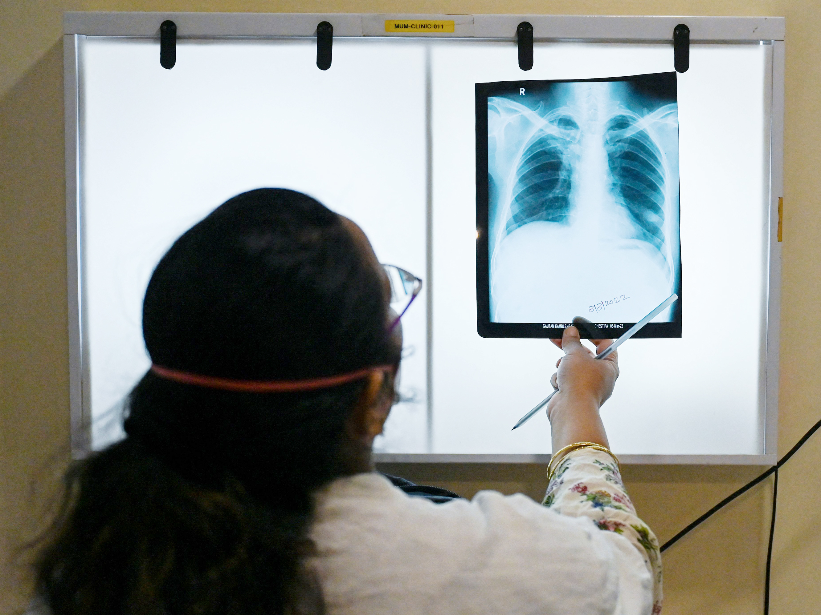 WHO says we can 'write the final chapter in the story of TB.' How close are we? - Vimarsana News
