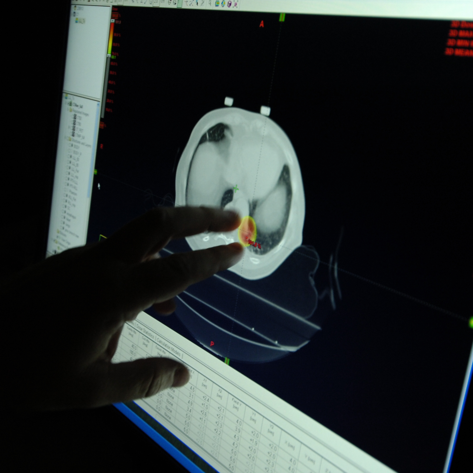 Lung cancer survival rates rise, but low screening rates leave many people at risk