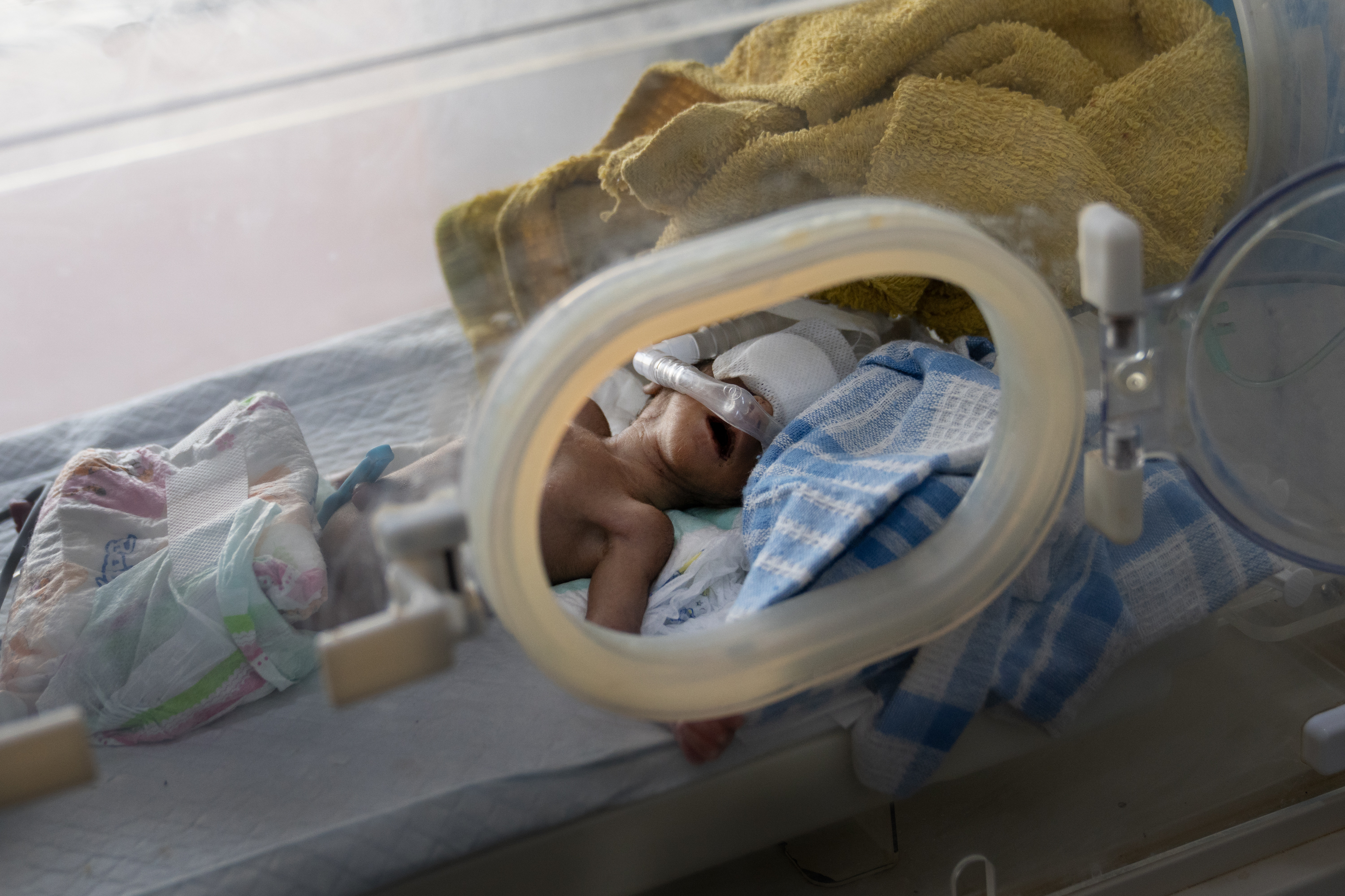 ADEN, YEMEN —A baby is being treated for malnutrition in the neonatal department at Al-Sadaqa hospital. Doctors say they do not have enough equipment or beds to treat all the babies in the unit. Click here for the full story.