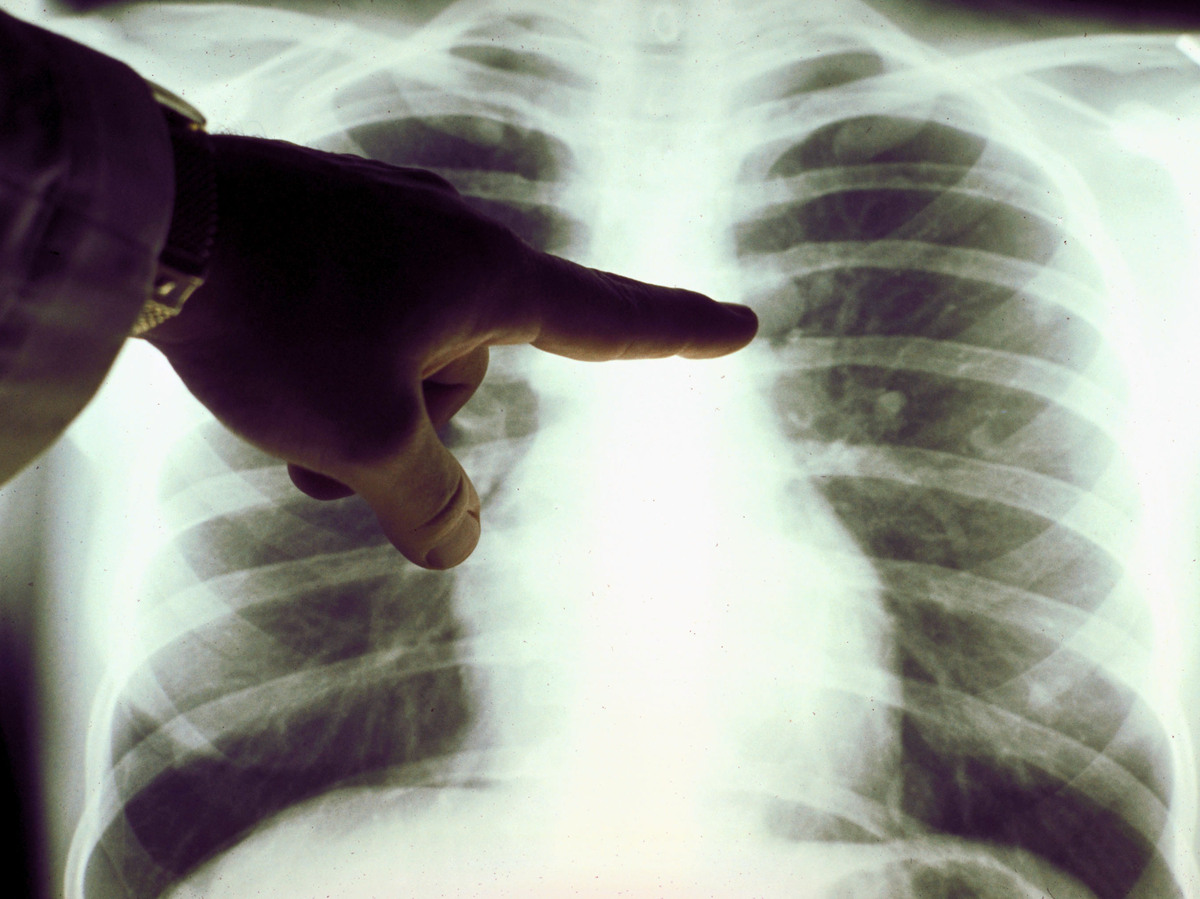 A view of a close up of a lung x-ray of a cigarette smoker in an undated photo.